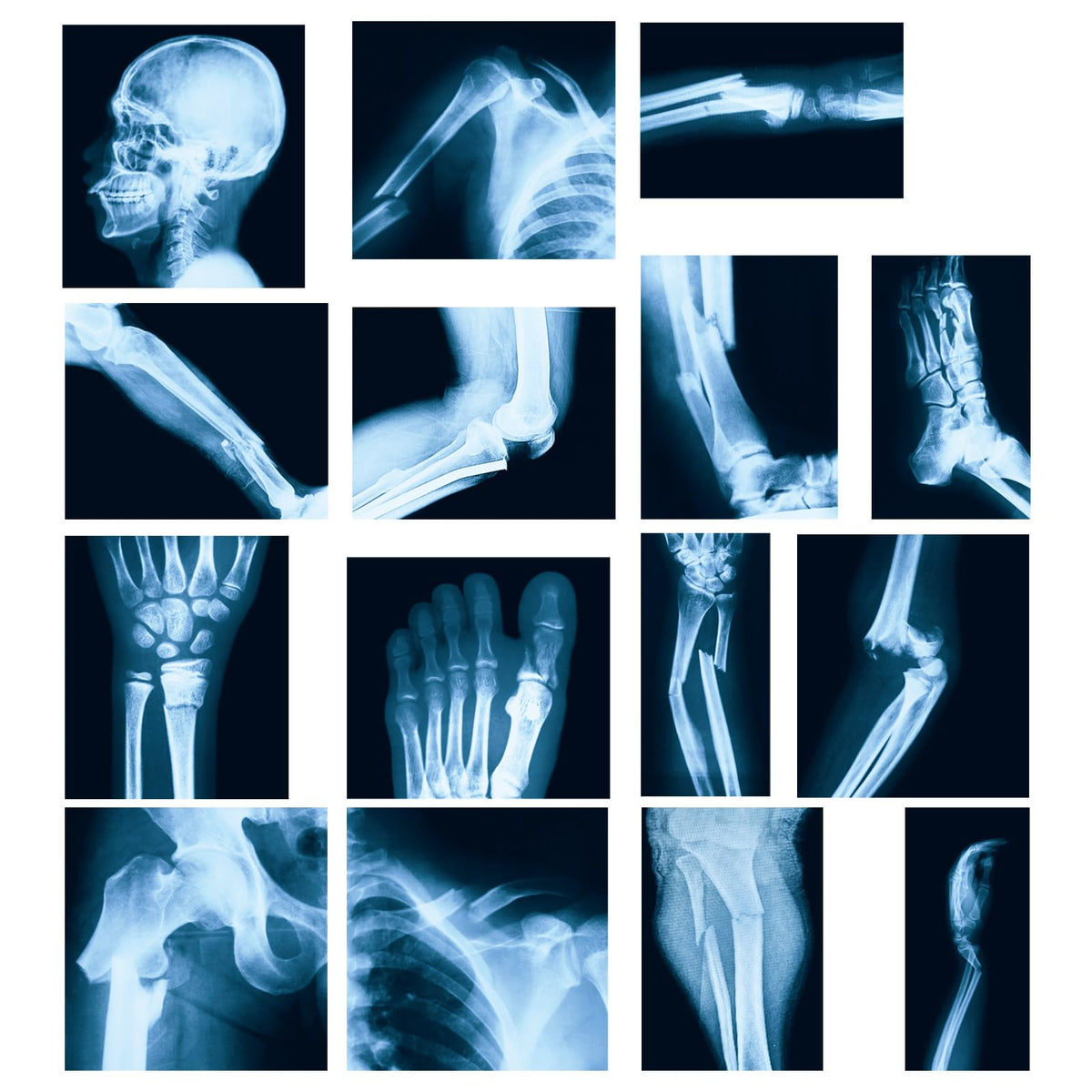 Sayglossy full 15-piece broken bones X-ray set for hands-on anatomy study