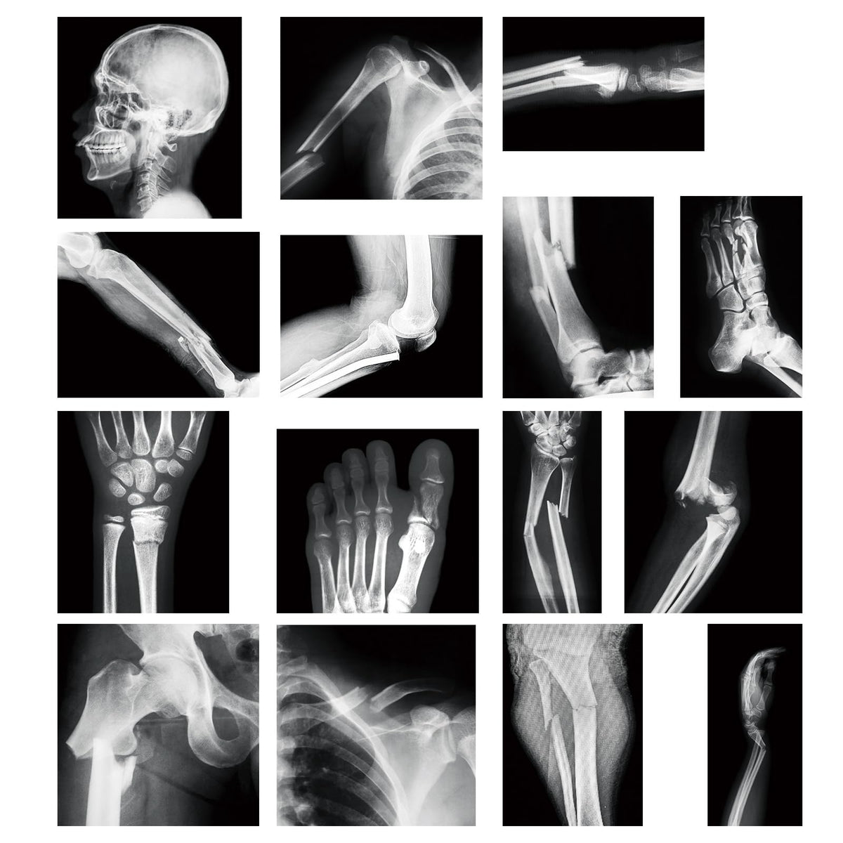 Sayglossy broken bones X-ray set front view, ideal for hands-on learning.