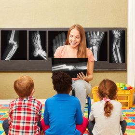 Sayglossy broken bones X-ray set contains 15 pieces for learning.